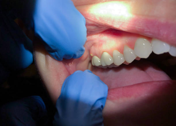 Best Broken or Cracked Tooth Emergency Dentist in Cloverdale, CA