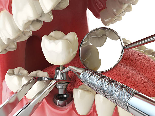 Best Broken or Cracked Tooth Emergency Dentist in Cloverdale, CA
